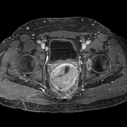 Rectal Cancer Radiology Reference Article Radiopaedia Org