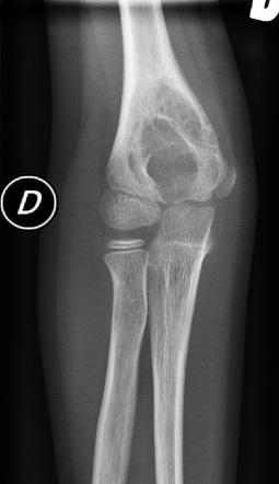 Aneurysmal bone cyst of the distal humerus | Radiology Case ...