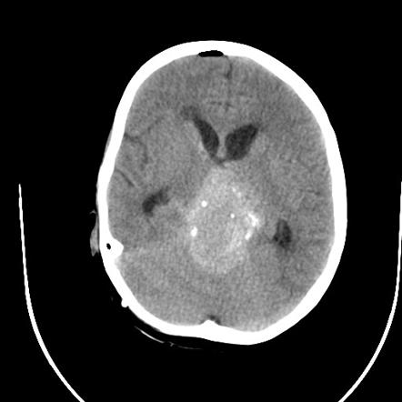 Intracranial tumors with calcification | Radiology Reference Article ...