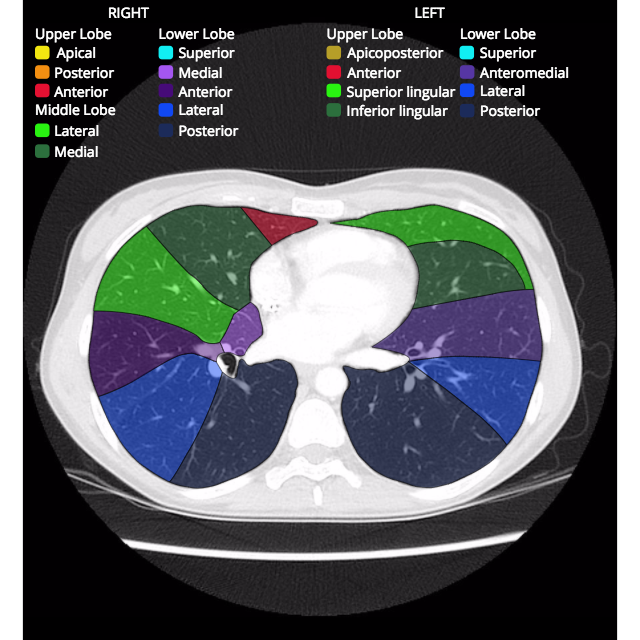 Bronchopulmonary segments: annotated CT | Image | Radiopaedia.org