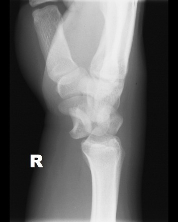 Lunate dislocation | Radiology Reference Article | Radiopaedia.org