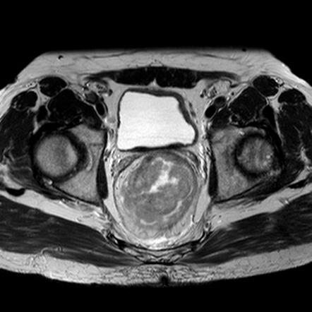 Rectal cancer - T3 | Radiology Case | Radiopaedia.org