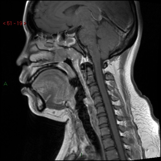 Nasopharyngeal carcinoma | Image | Radiopaedia.org