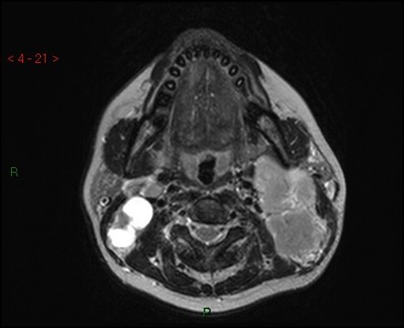 Nasopharyngeal Carcinoma Radiology Case Radiopaediaorg