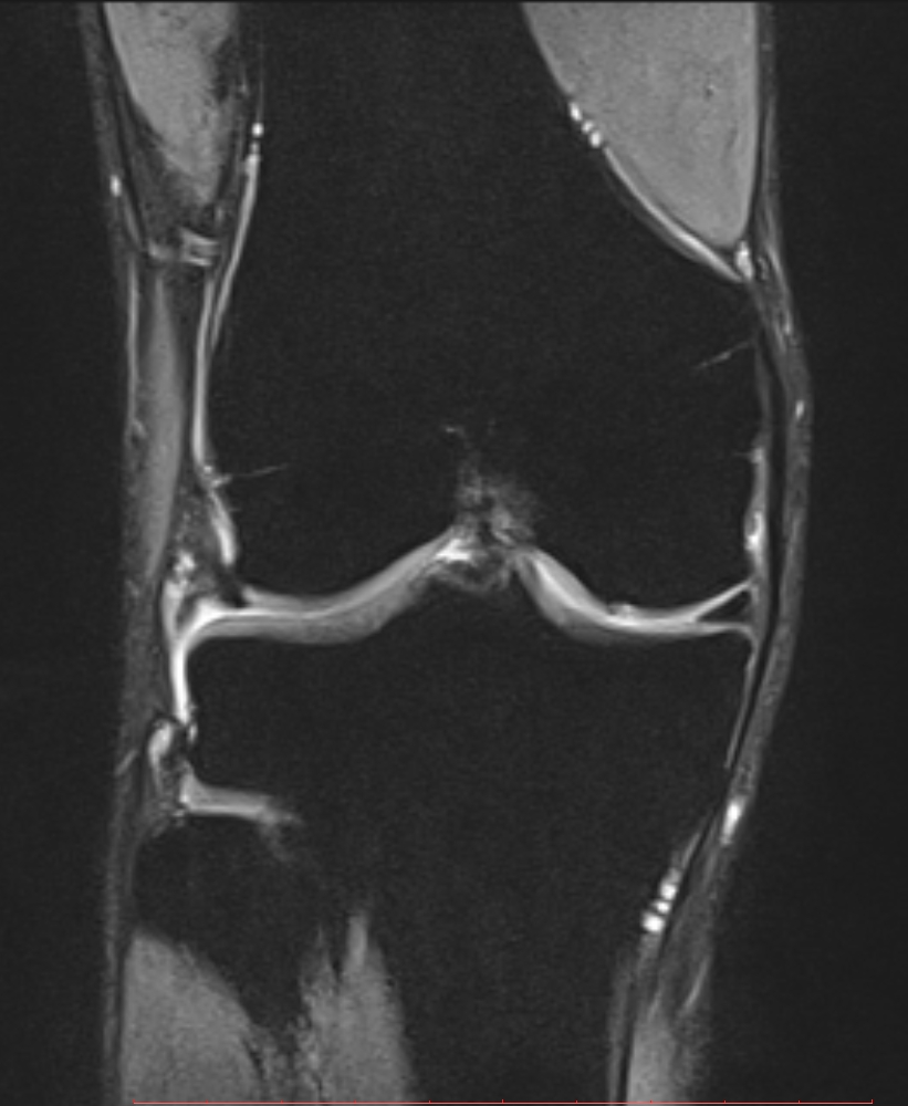 Anterior crutiate ligament tear | Image | Radiopaedia.org