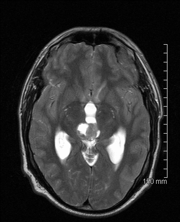 Pineoblastoma | Radiology Case | Radiopaedia.org