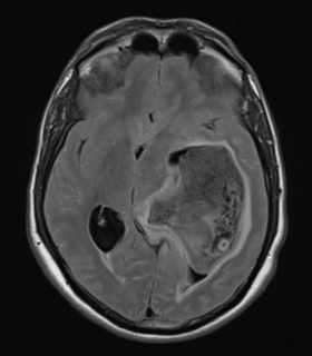 Diffuse low grade astrocytoma (grade II) with intraventricular ...