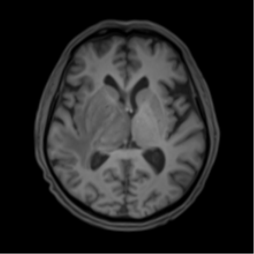 Cerebral toxoplasmosis | Image | Radiopaedia.org