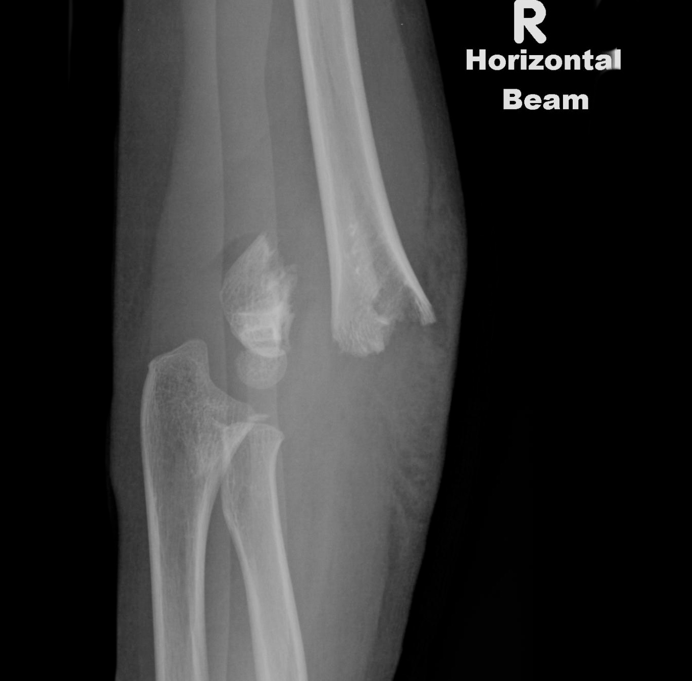 grading supracondylar fracture