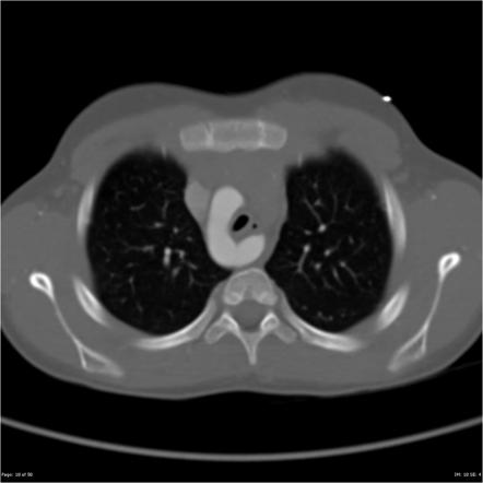 Right-sided aortic arch | Radiology Reference Article | Radiopaedia.org