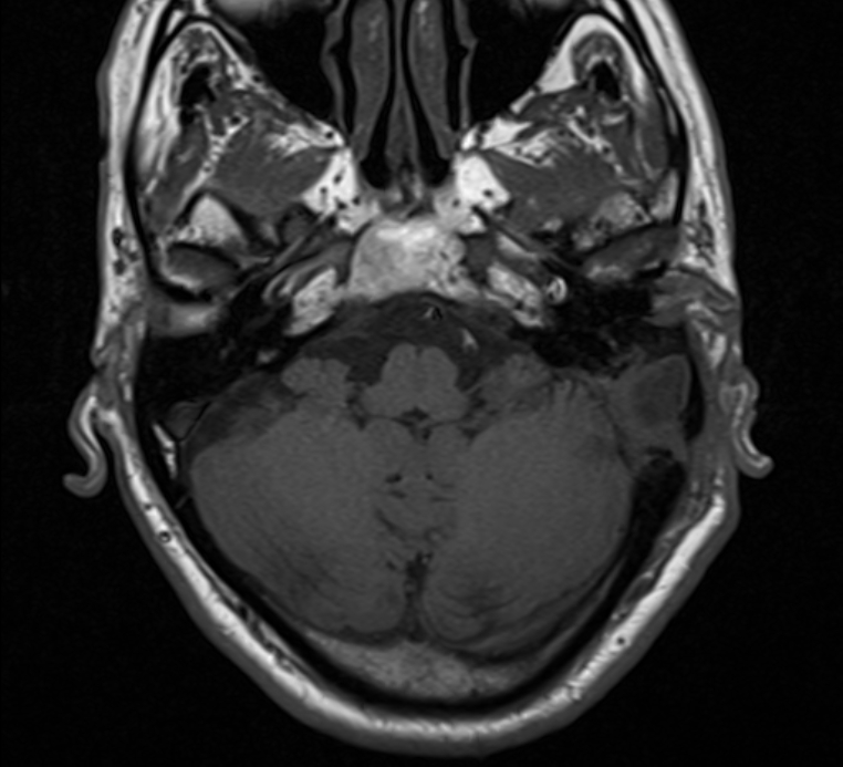 Cholesteatoma | Image | Radiopaedia.org