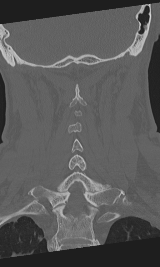 Ossification Of The Posterior Longitudinal Ligament Image