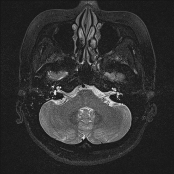 Tympanic paraganglioma | Image | Radiopaedia.org