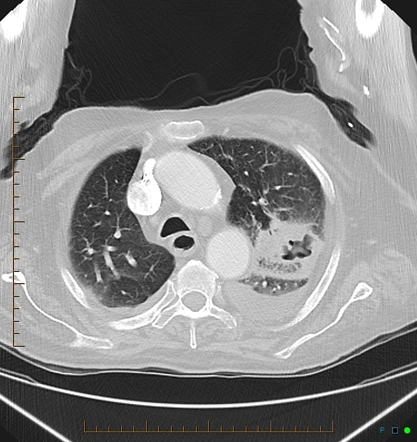 Cavitary Pulmonary Infarction Radiology Reference Article Radiopaedia Org