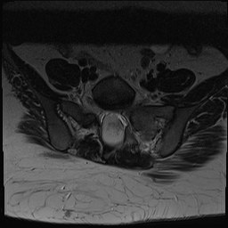 Lipomyelomeningocele with tethered cord | Image | Radiopaedia.org