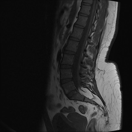 Lipomyelomeningocele with tethered cord | Image | Radiopaedia.org