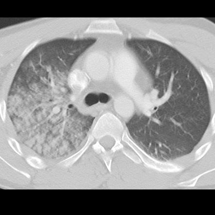 Pulmonary Contusion | Radiology Reference Article | Radiopaedia.org