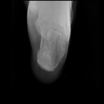 Calcaneus X Ray