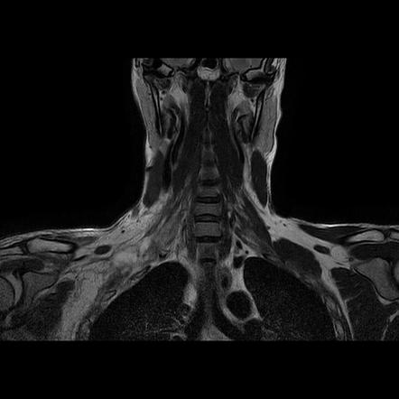 Brachial plexus injury | Image | Radiopaedia.org