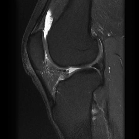 Insall-Salvati ratio - normal patella | Radiology Case | Radiopaedia.org