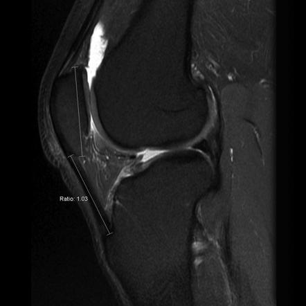 Insall-Salvati ratio | Radiology Reference Article | Radiopaedia.org