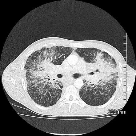 Viewing playlist: Coarse reticular opacities | Radiopaedia.org