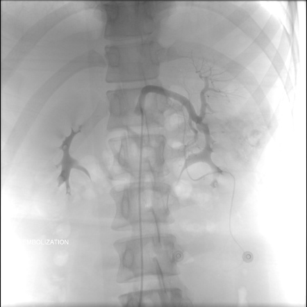 Splenic laceration - AAST grade IV | Image | Radiopaedia.org