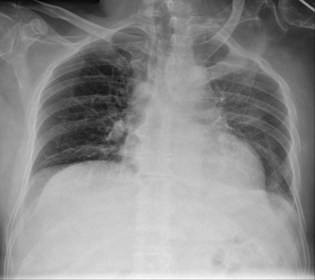 Multiple rib fractures with flail segment and hemothorax | Image ...