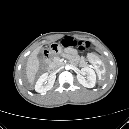 Splenic laceration - AAST grade IV | Radiology Case | Radiopaedia.org