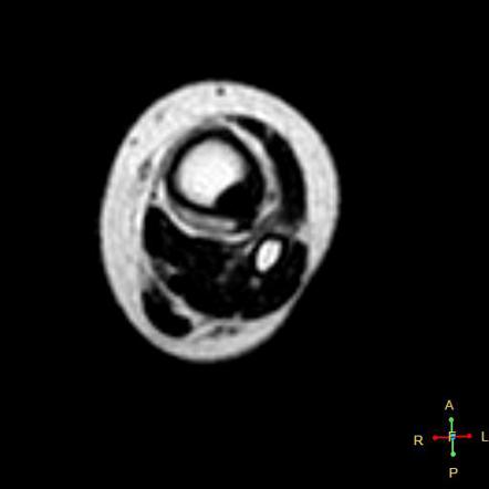 Fibrous cortical defect - on MRI | Image | Radiopaedia.org