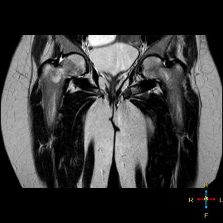 Polyostotic fibrous dysplasia - on MRI | Radiology Case | Radiopaedia.org