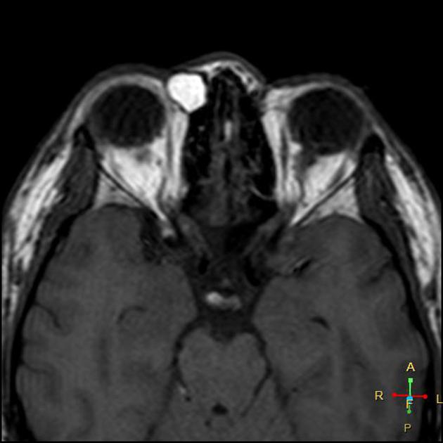 Orbital Dermoid Cyst Radiology Reference Article