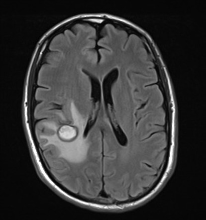 Cerebral metastasis - melanoma | Radiology Case | Radiopaedia.org