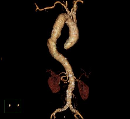 Thoracic Aortic Aneurysm Radiology Reference Article Radiopaedia Org