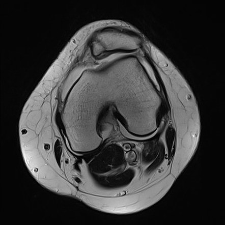 Lateral patellar dislocation | Image | Radiopaedia.org