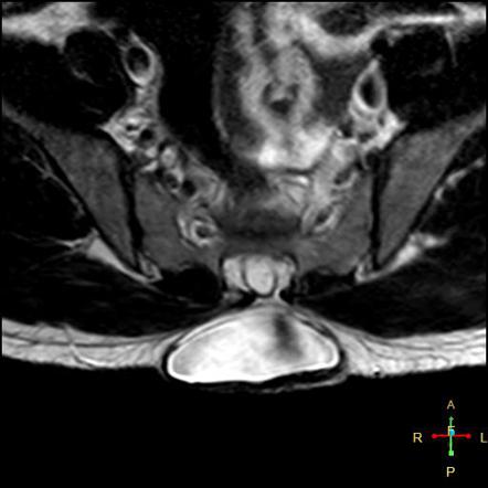 spina bifida mri