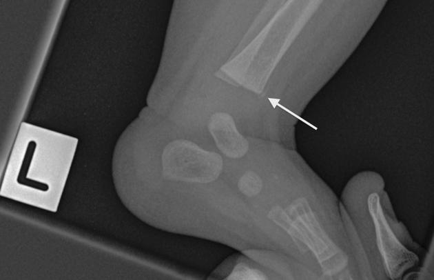 Metaphysis, Radiology Reference Article