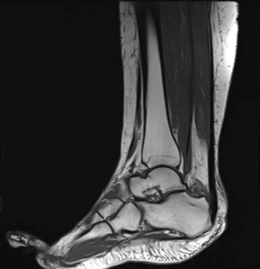 Haglund syndrome | Image | Radiopaedia.org