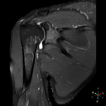 Subscapularis Tendon Tear Orthopaedicprinciplescom