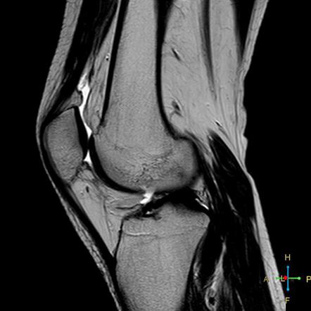 Osteochondral fracture | Radiology Case | Radiopaedia.org