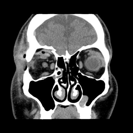 Orbital Bone Fracture