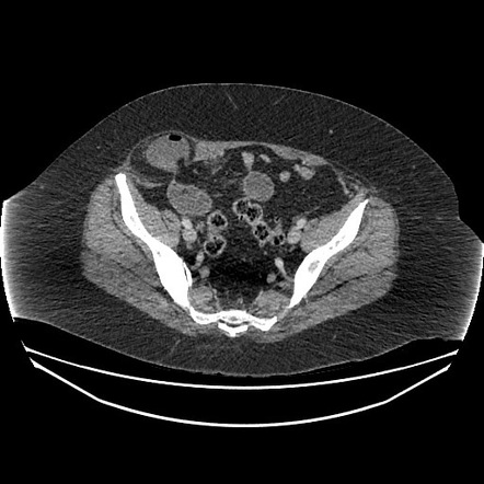 Spigelian hernia | Radiology Reference Article | Radiopaedia.org