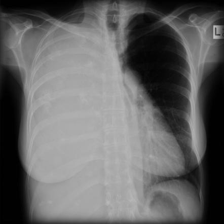 Mesothelioma - sarcomatoid | Radiology Case | Radiopaedia.org