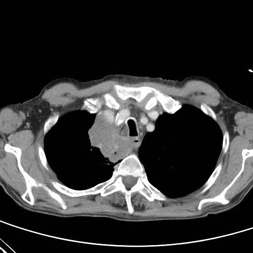 Superior Vena Cava Syndrome With Tumor-induced Hepatisation Of The Lung 