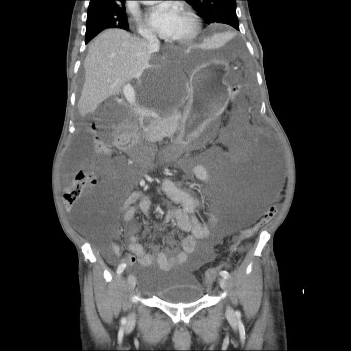 Pseudomyxoma Peritonei Image 1308