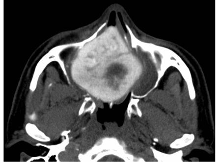 central cementifying fibroma