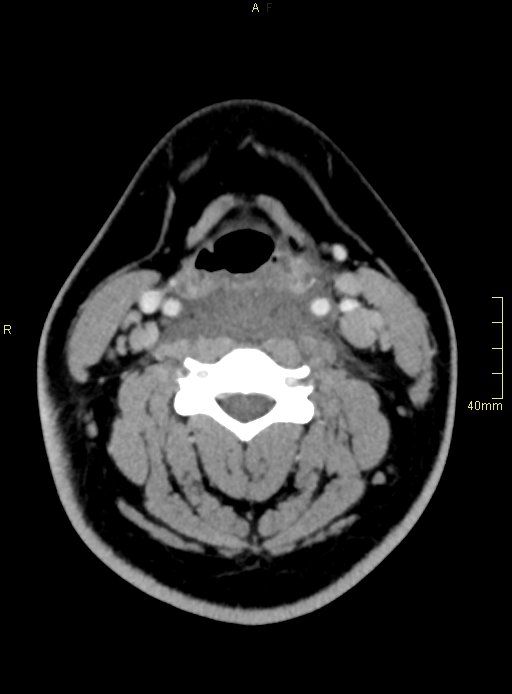 FDM Training Center - #Repost @med.case • • • • • • The #steeple sign (some  may call it pencil sign ✏️) is a radiologic sign found on a frontal neck  radiograph