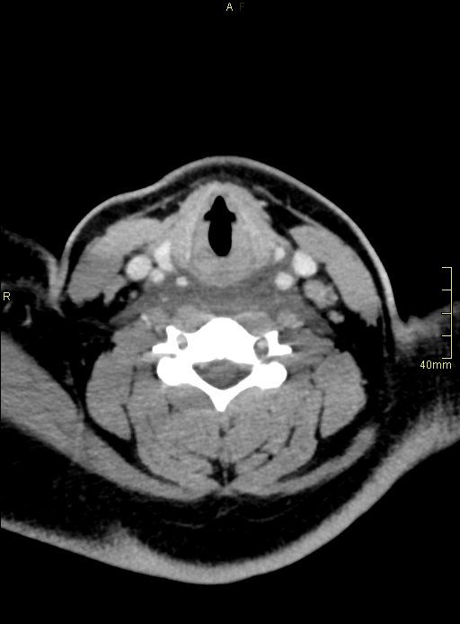 FDM Training Center - #Repost @med.case • • • • • • The #steeple sign (some  may call it pencil sign ✏️) is a radiologic sign found on a frontal neck  radiograph