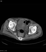 Metaplasia | Radiology Reference Article | Radiopaedia.org