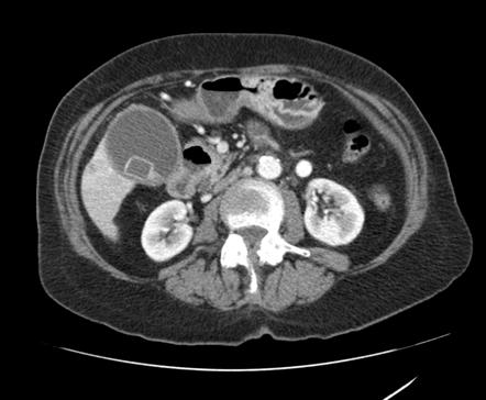 Gallbladder carcinoma with cholelithiasis | Image | Radiopaedia.org